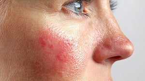 Why Dermatology-Tested Products Are Safer for Sensitive, Acne-Prone Skin?